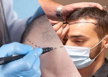 Türkiye saç ekiminde dünya lideri oldu